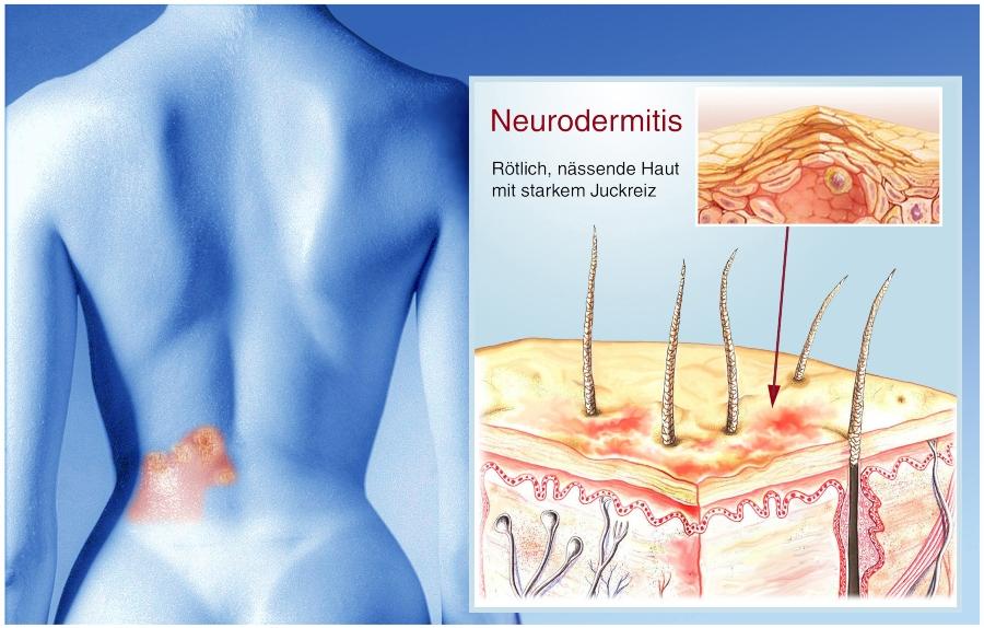 neurodermitis-haut-juckreiz