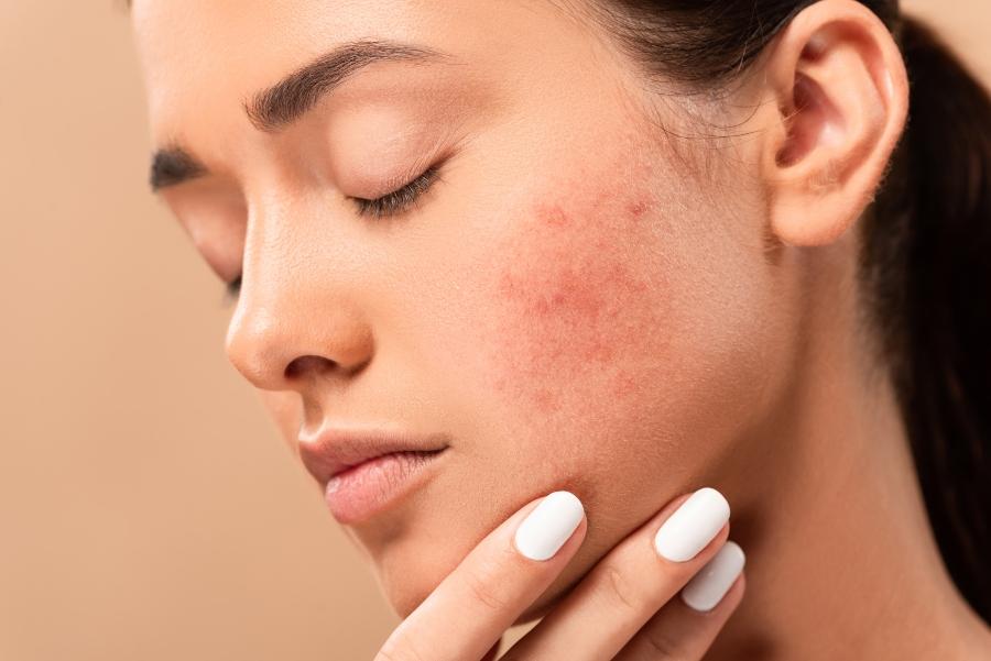 Hautverunreinigungen Pflegeroutine bei unreiner Haut