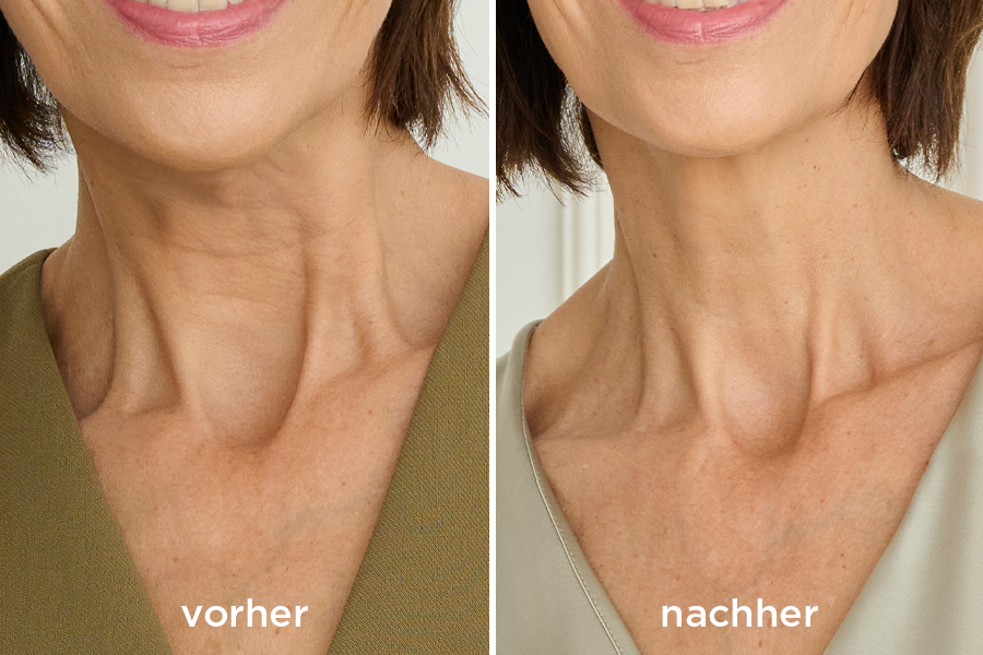 La mer Truthahnhals vorher/nachher