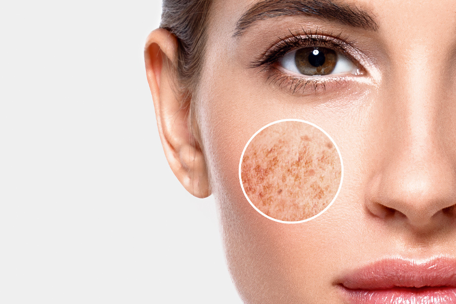 Ultrasun Produkte Melasma