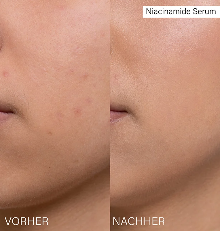 Niacinamide Serum, 30ml