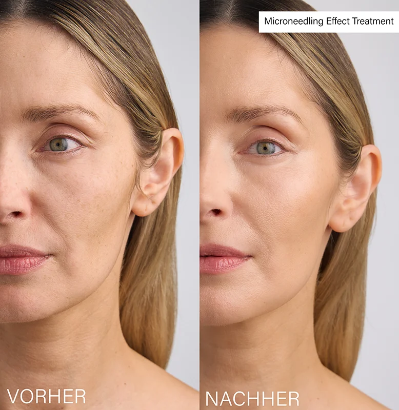 Microneedling Effect Treatment, 30ml